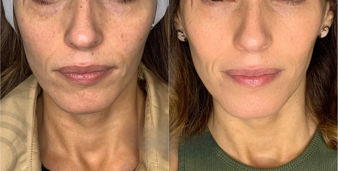 Dermapen Skinbooster